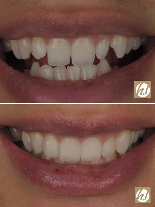 Composite Veneering
